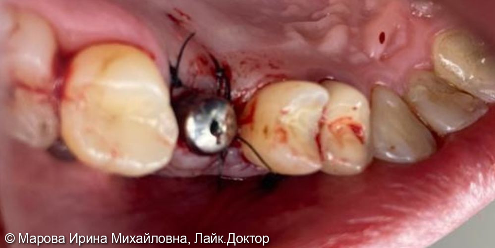 Имплантация в проекции зуба 1.6 - фото №1