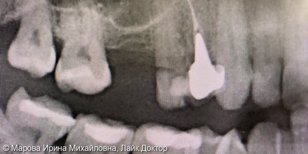 Имплантация в проекции зуба 1.6 - фото №6