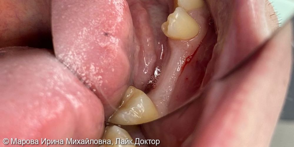 Имплантация зубов нижней челюсти - фото №1