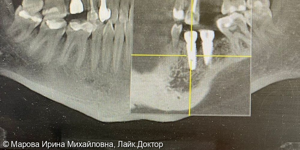 Имплантация зубов нижней челюсти - фото №4