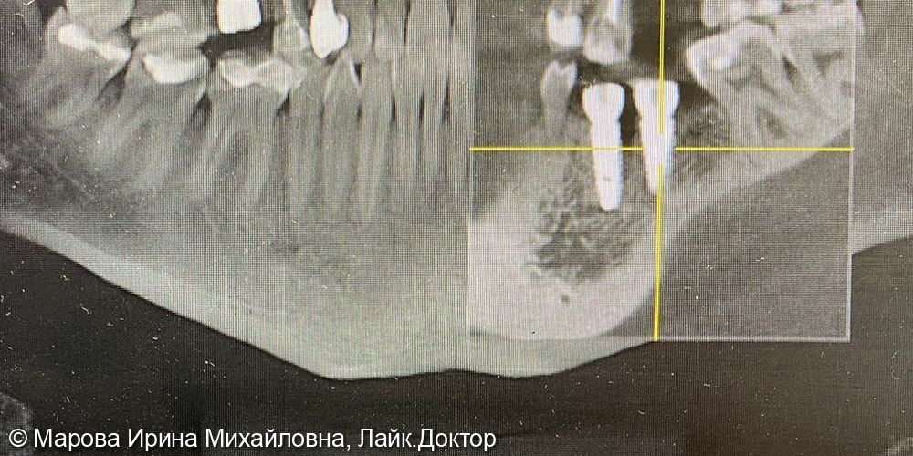 Имплантация зубов нижней челюсти - фото №5