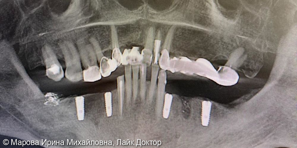 Частичная вторичная адентия - фото №8
