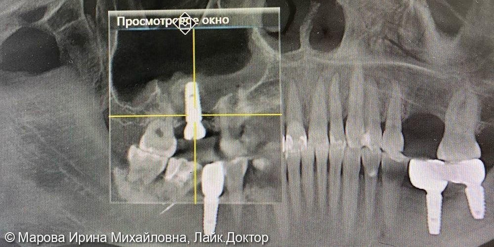 Имплантация - фото №3