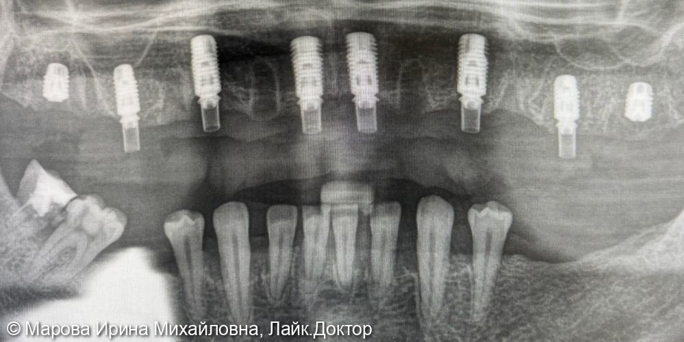 Имплантация фото 2 · Вологда