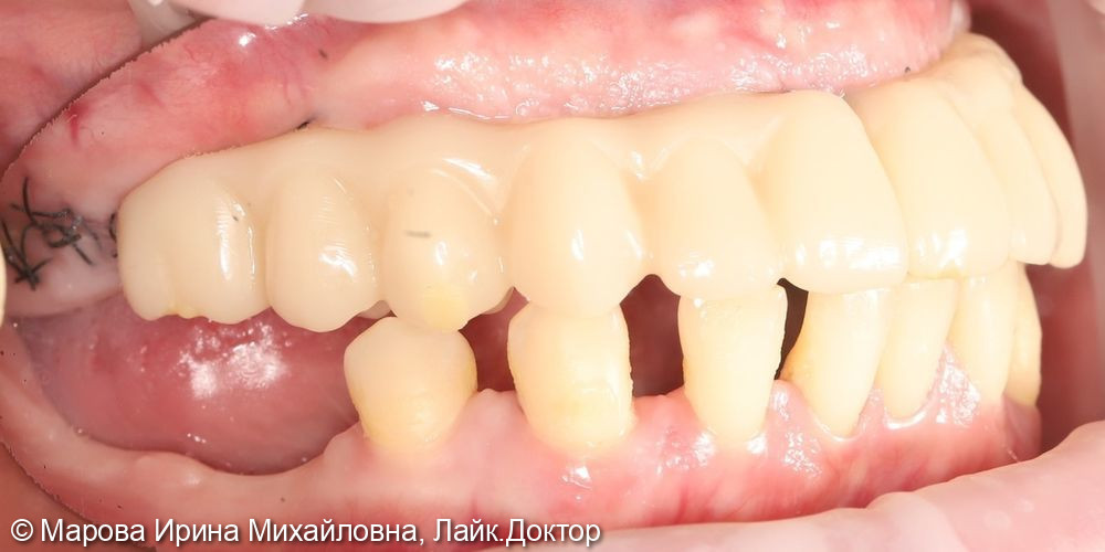 Имплантация фото 3 · Вологда