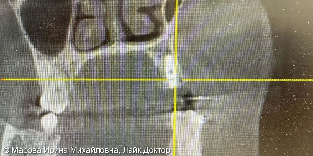 Имплантация фото 2 · Вологда