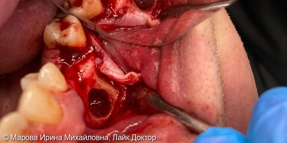 Имплантация фото 2 · Вологда