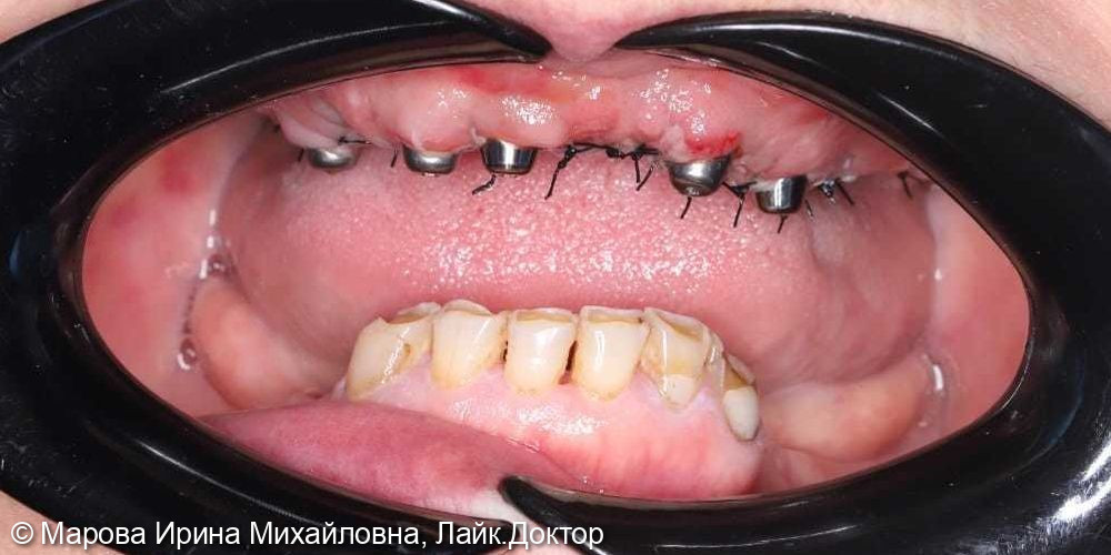 Имплантация фото 2 · Вологда