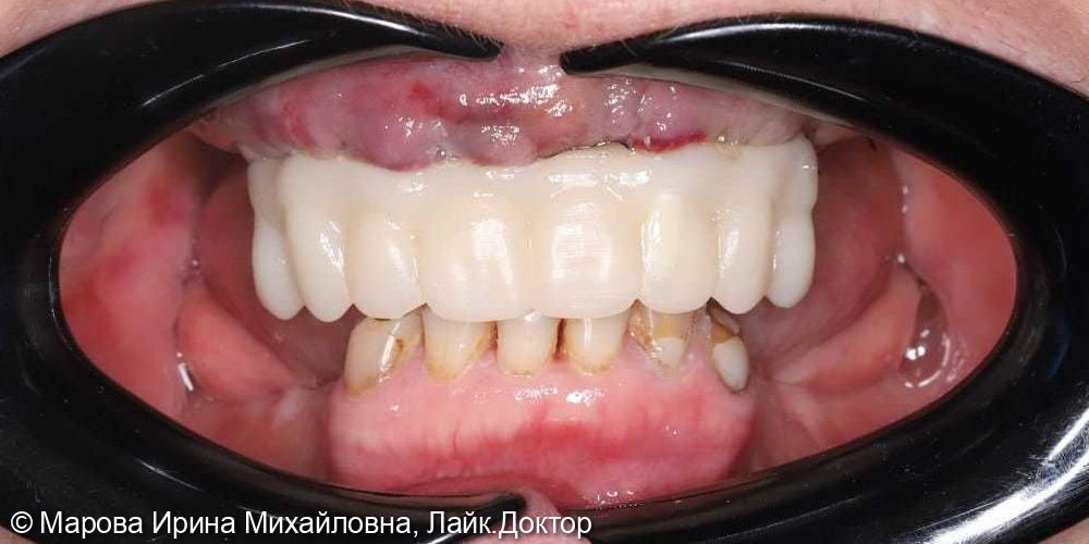 Имплантация фото 4 · Вологда