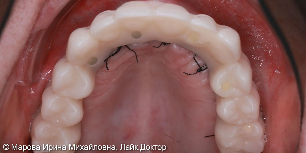 Имплантация фото 2 · Вологда