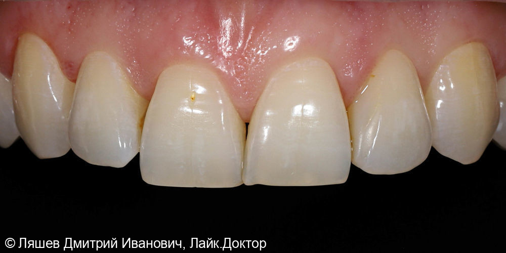 Профгигиена и отбеливание зубов ZOOM 4 - фото №1