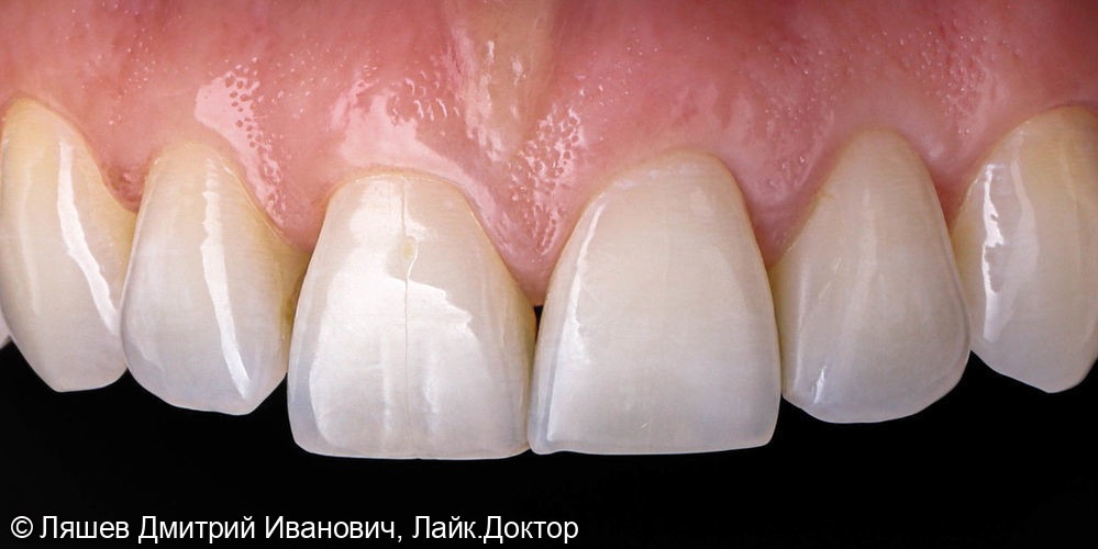 Профгигиена и отбеливание зубов ZOOM 4 - фото №2