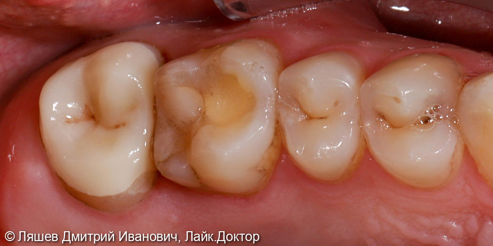 Восстановлении зуба керамической вкладкой по технологии CAD/CAM CEREC - фото №2