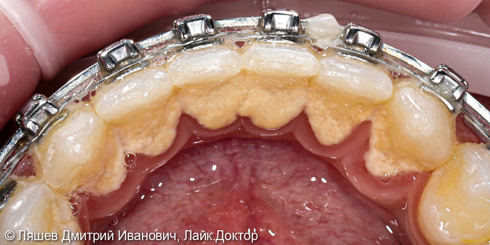 Чистка зубов при ношении брекет-системы - фото №1