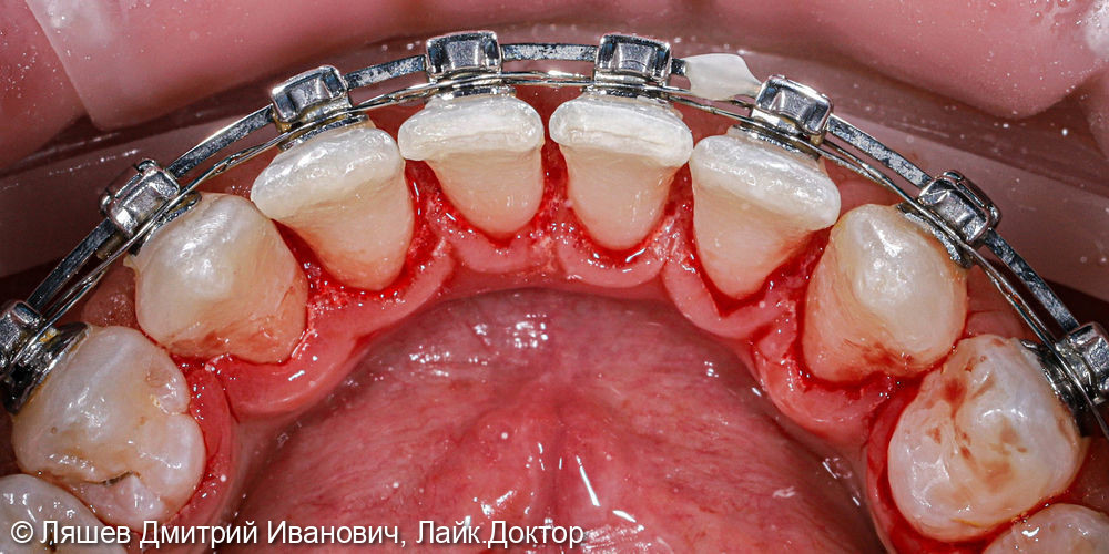 Чистка зубов при ношении брекет-системы - фото №2
