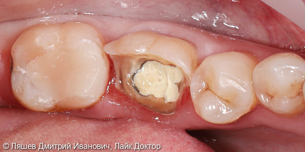 Восстановление зуба керамической вкладкой по технологии CAD/CAM CEREC - фото №1