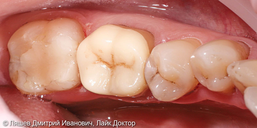 Восстановление зуба керамической вкладкой по технологии CAD/CAM CEREC - фото №3