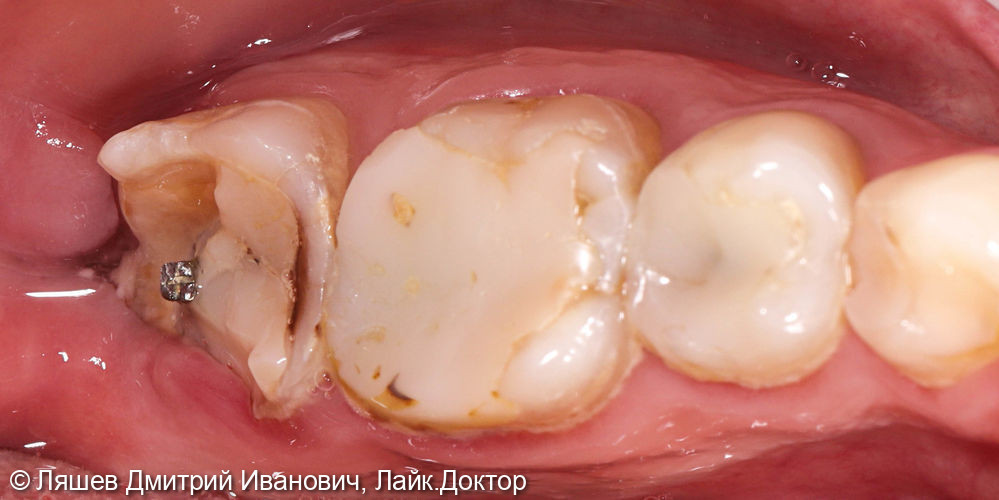 Разрушен зуб на нижней челюсти, восстановление керамической вкладкой - фото №1