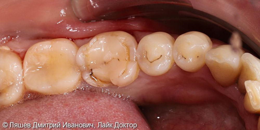 Скол стенки зуба на нижней челюсти слева - фото №1
