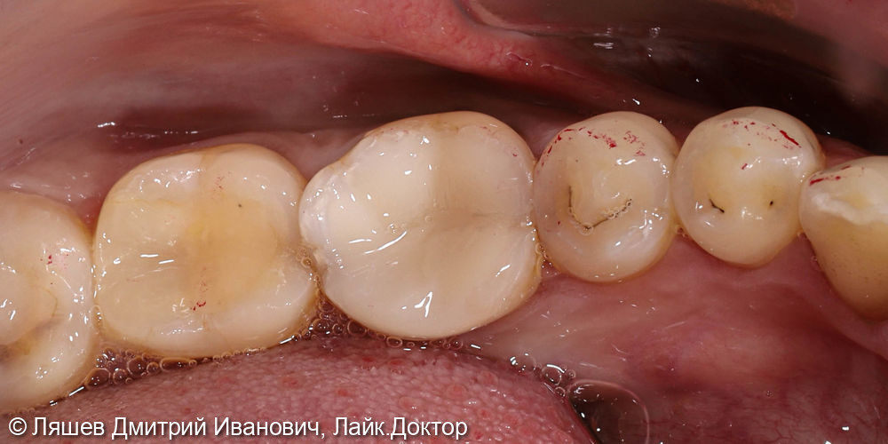 Скол стенки зуба на нижней челюсти слева - фото №2