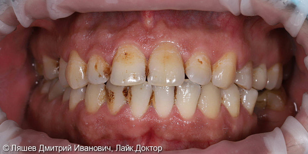 Жалобы на кровоточивость десен при чистке зубов - фото №1