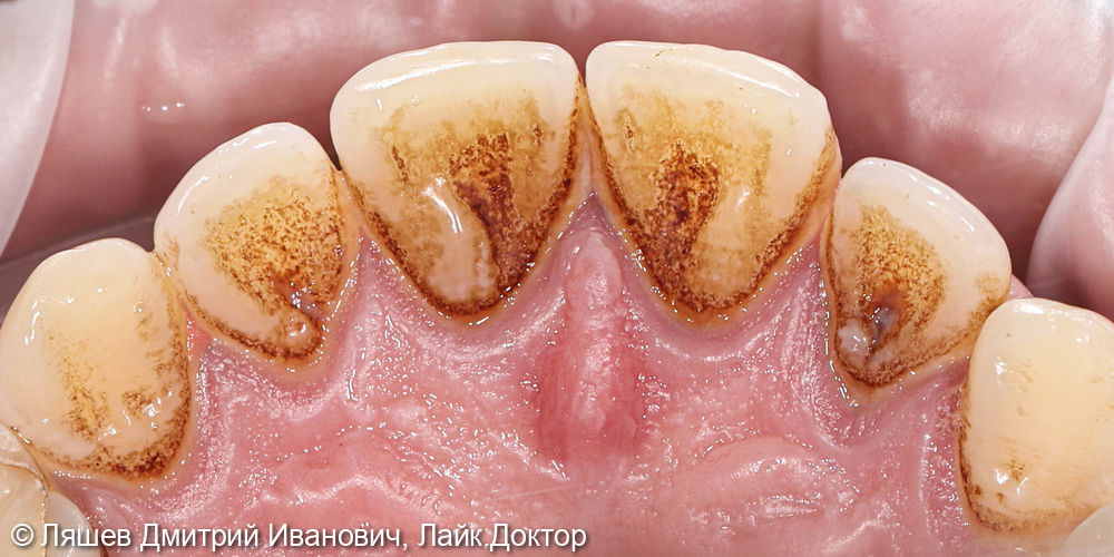 Жалобы на кровоточивость десен при чистке зубов - фото №2