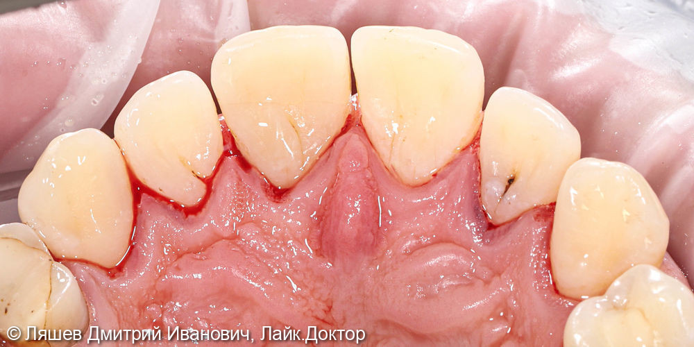 Жалобы на кровоточивость десен при чистке зубов - фото №3