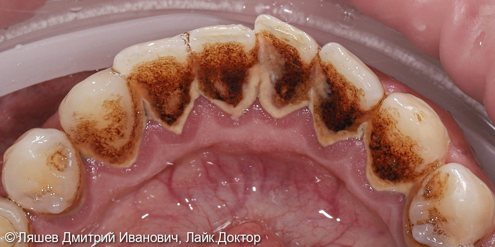 Жалобы на кровоточивость десен при чистке зубов - фото №4