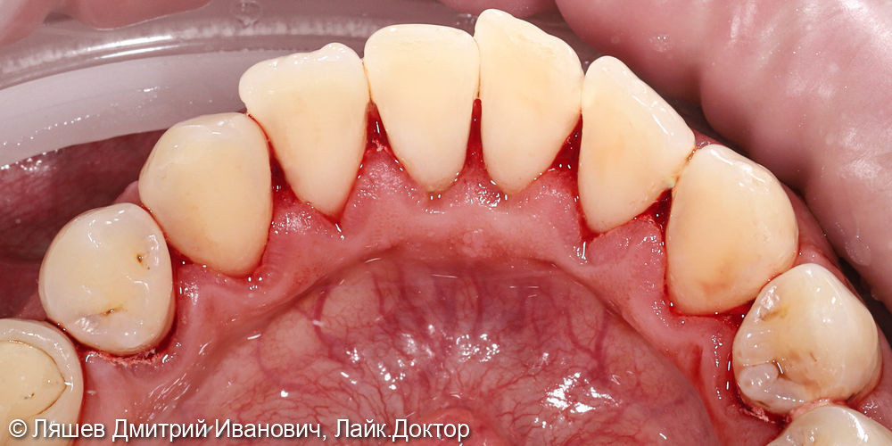 Жалобы на кровоточивость десен при чистке зубов - фото №5