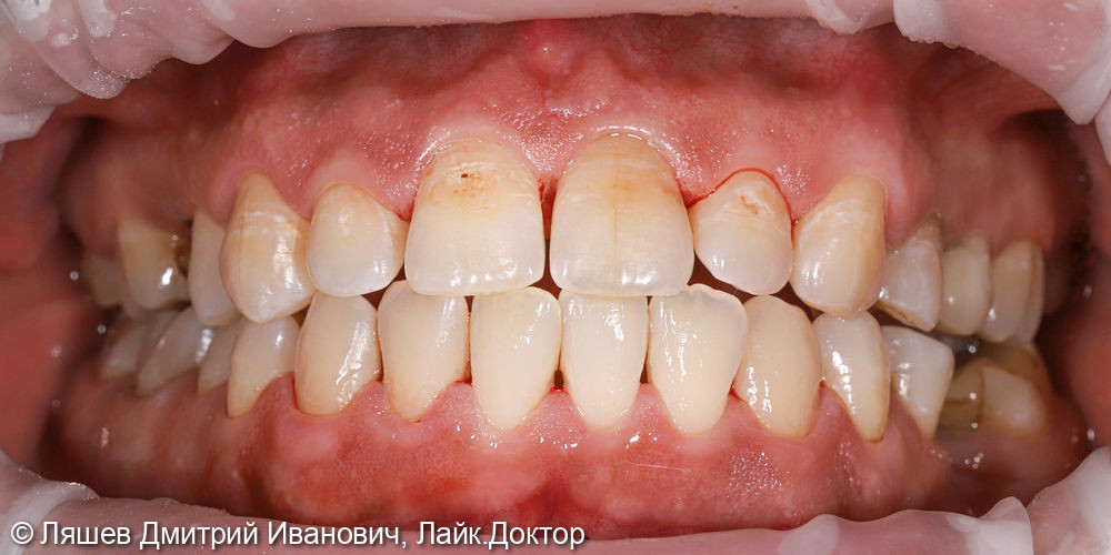 Жалобы на кровоточивость десен при чистке зубов - фото №6
