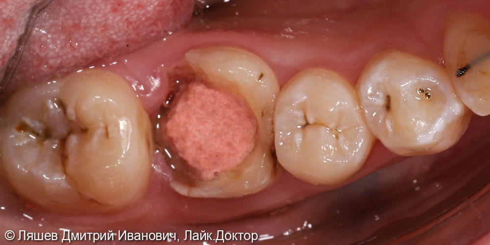 Восстановлении зуба керамической вкладкой по технологии CAD/CAM CEREC - фото №1