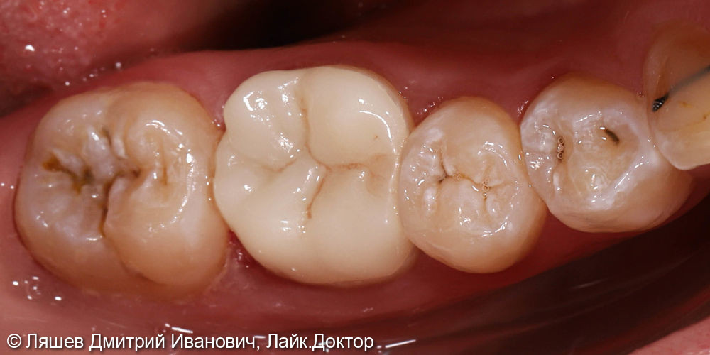 Восстановлении зуба керамической вкладкой по технологии CAD/CAM CEREC - фото №2