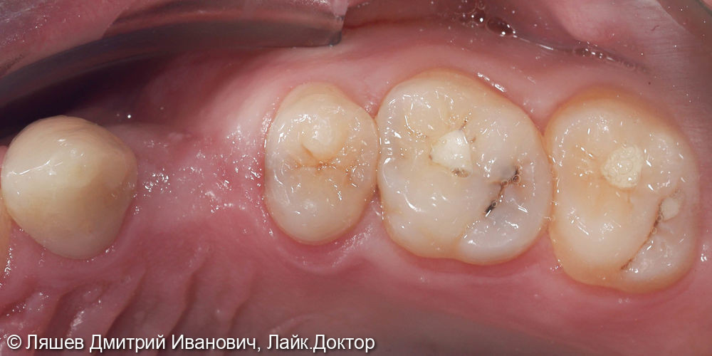 Кариес дентина зуба 2.6 - фото №2