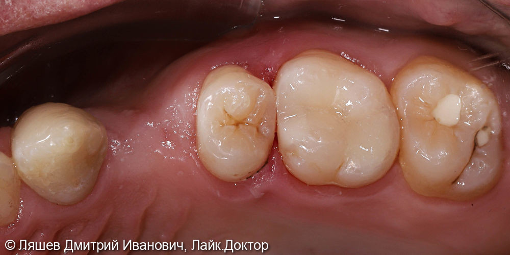 Кариес дентина зуба 2.6 - фото №3