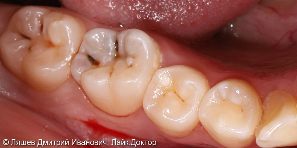 Кариес дентина зуба 4.6 - фото №1