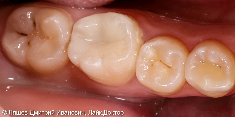 Кариес дентина зуба 4.6 - фото №2