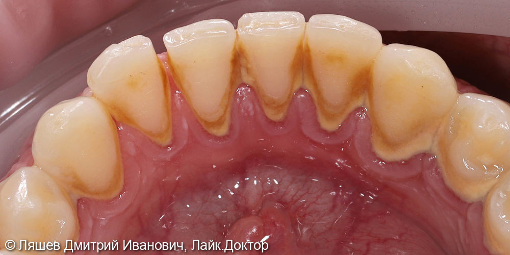 Жалобы на кровоточивость десен при чистке зубов, наличие налета - фото №1