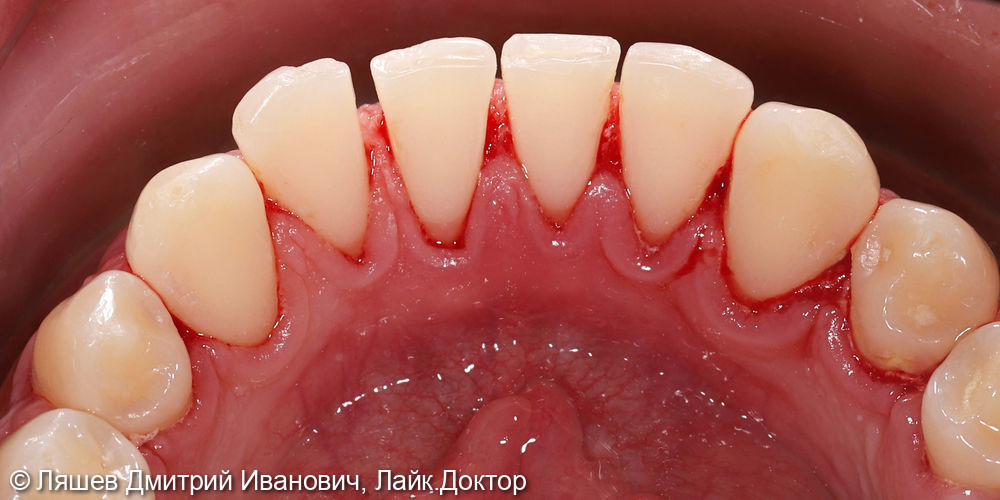 Жалобы на кровоточивость десен при чистке зубов, наличие налета - фото №2