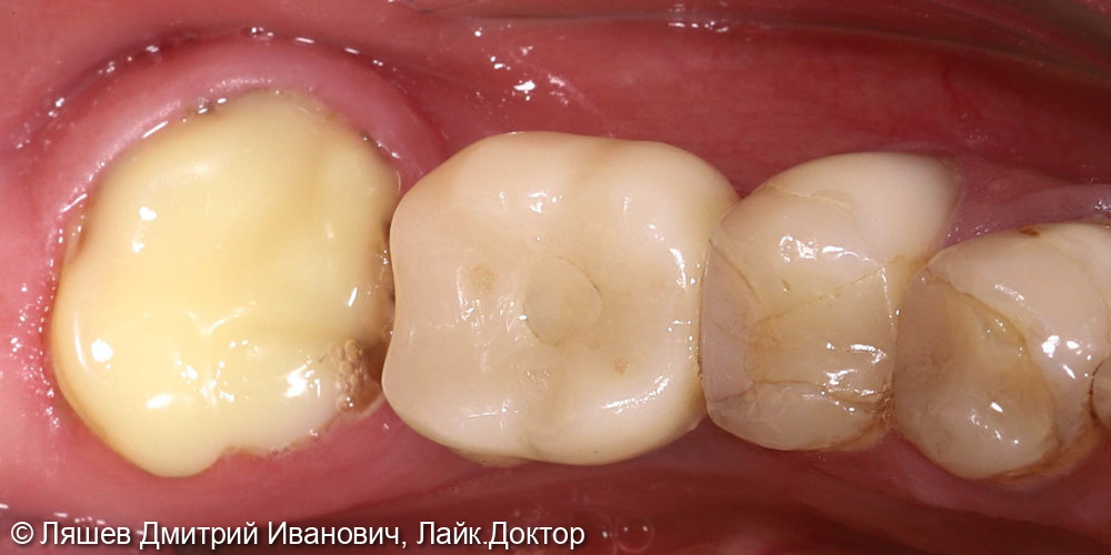 Восстановления коронковой части зуба - фото №1