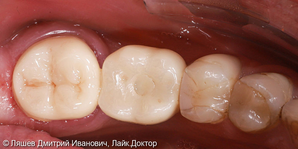 Восстановления коронковой части зуба - фото №2