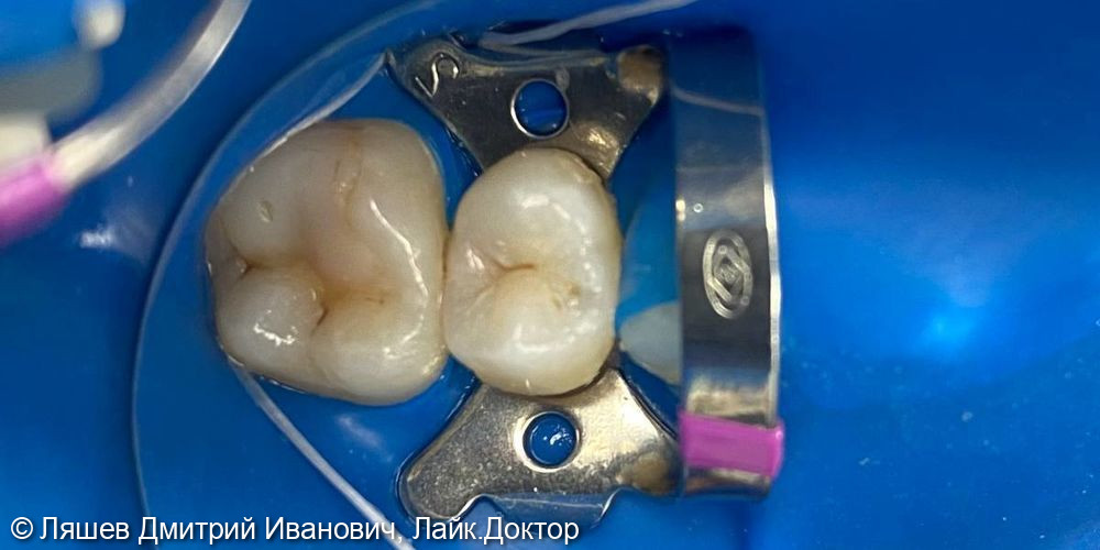 Кариес дентина зуба 1.5 - фото №1