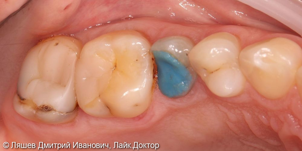 Кариес депульпированного зуба 2.5 2.7 - фото №1