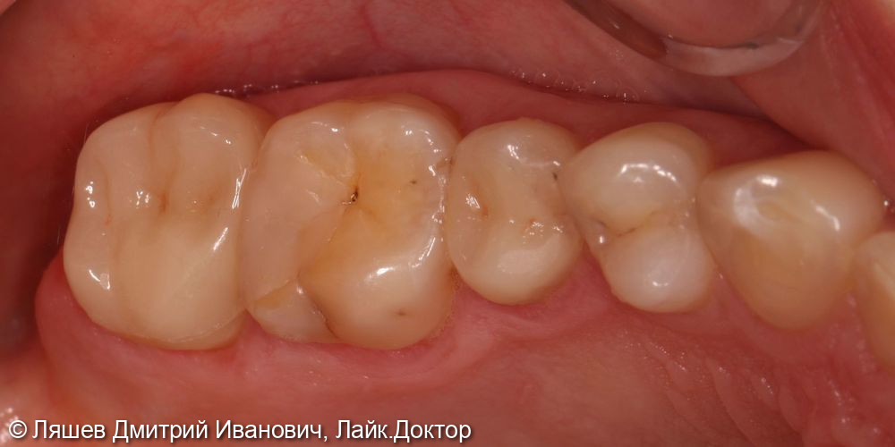 Кариес депульпированного зуба 2.5 2.7 - фото №2