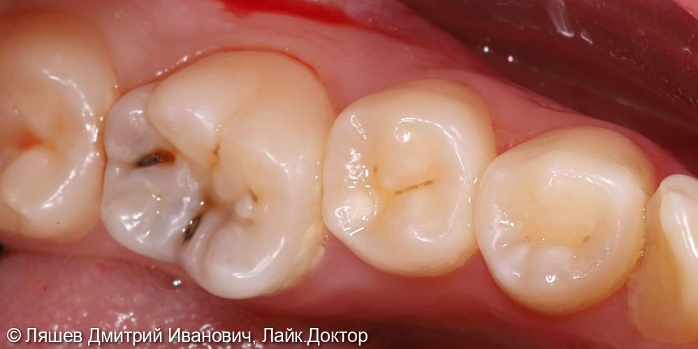 Лечение кариеса зуба 3.6 - фото №1
