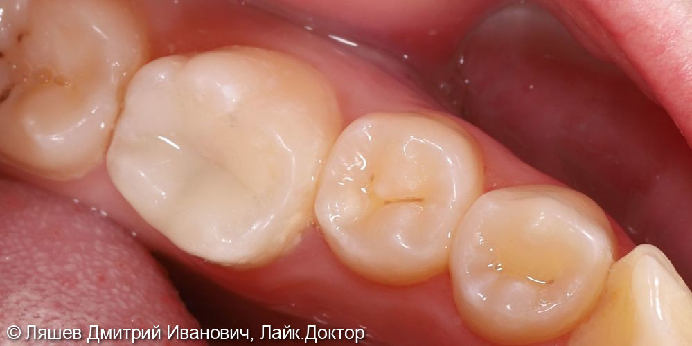 Лечение кариеса зуба 3.6 - фото №2
