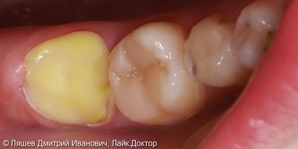 Лечение кариеса зуба 4.7 - фото №1