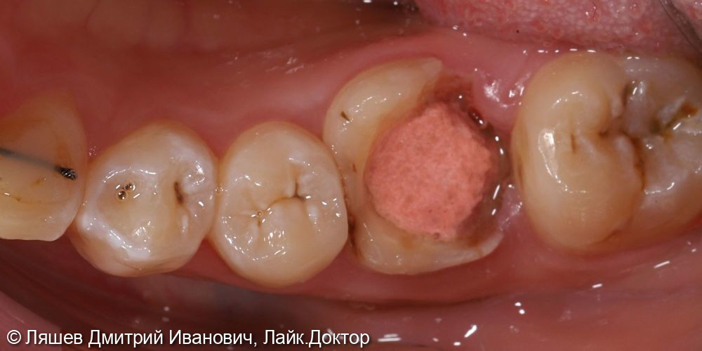 Кариес депульпированного зуба 3.6 - фото №1