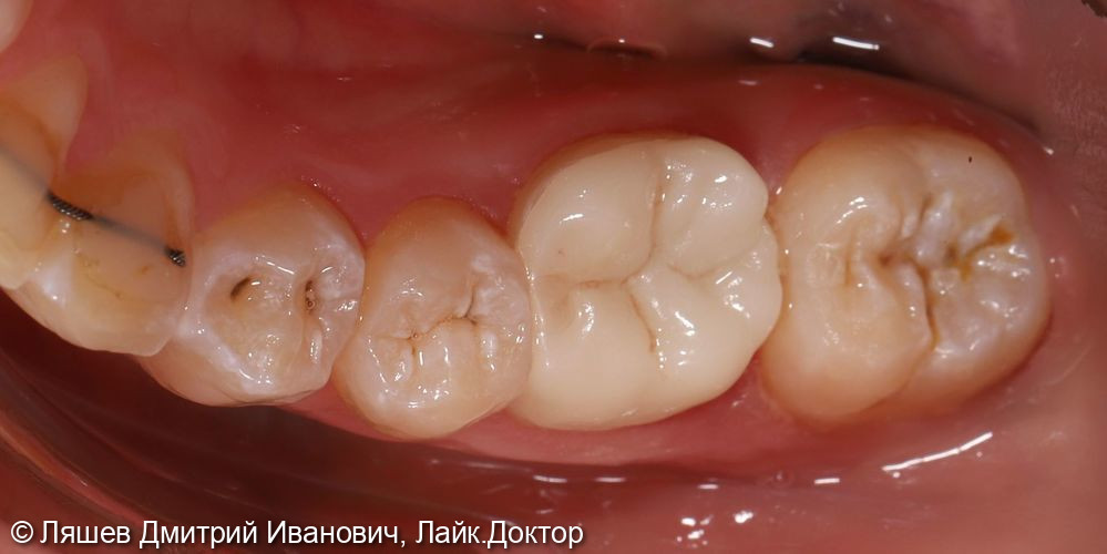 Кариес депульпированного зуба 3.6 - фото №2