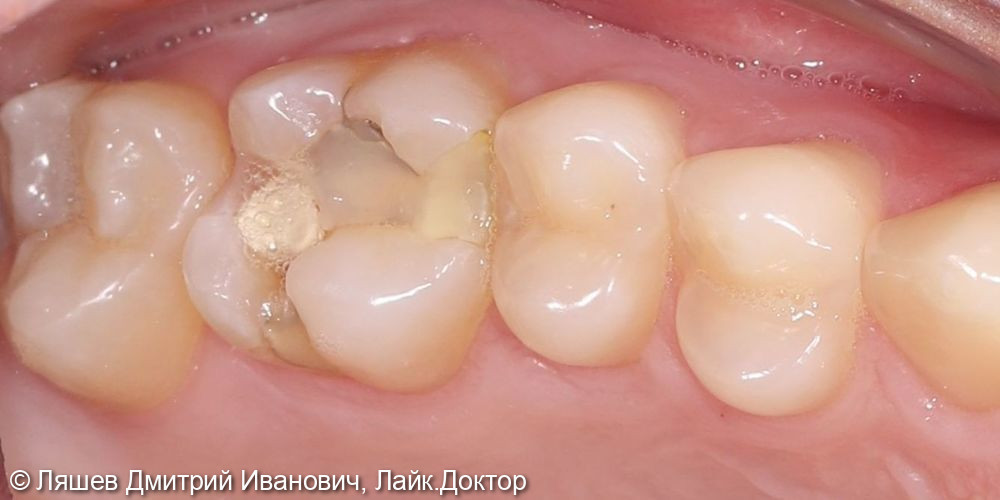 Кариес дентина зуба 1.6 - фото №1