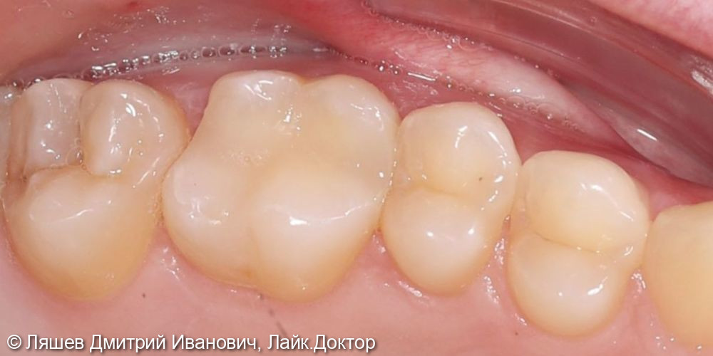 Кариес дентина зуба 1.6 - фото №2